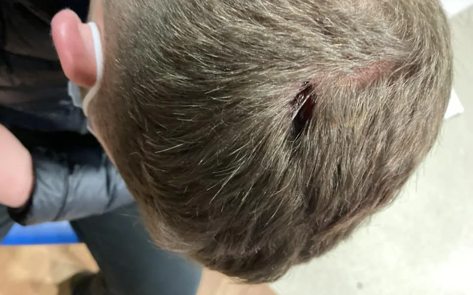 Photo of the injury sustained by a 16-year-old boy from Whittlesey after he was attacked by two women, one of whom has now been given a 12 months suspended prison sentence.